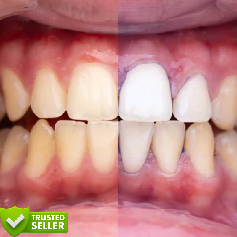 Purple V34™ | Weiße Zähne in nur 5 Minuten